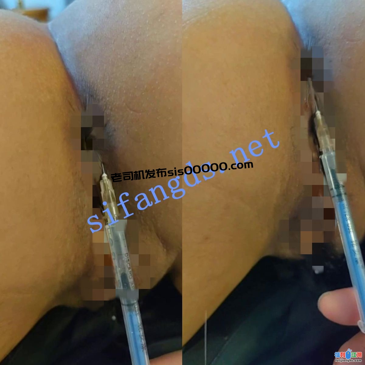 ❤️【打针】真实打针 屁股 屁眼 阴部看着都疼！【0.42G】